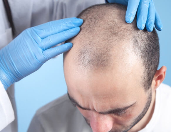 Hair Transplant Big Fue Hair Transplant Big Fue image